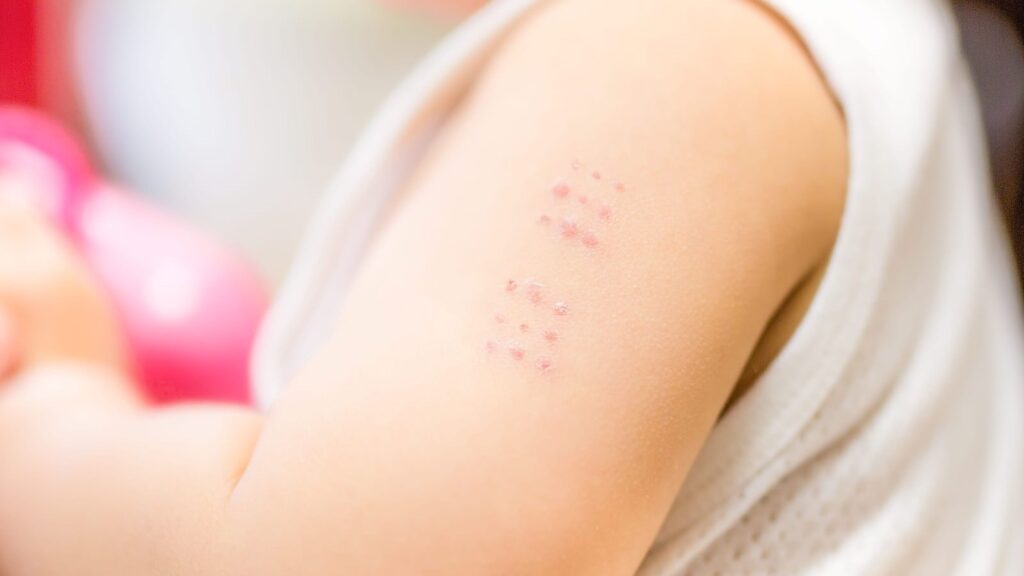 BCGワクチン接種後の子どもの上腕に残る接種痕