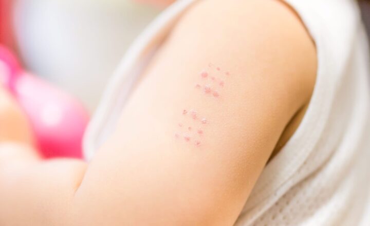 BCGワクチン接種後の子どもの上腕に残る接種痕